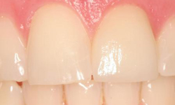 After image of left front tooth repaired
