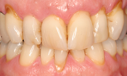 Misaligned teeth with visible decay and periodontal disease