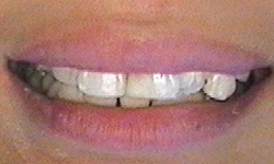 After image of straightened smile