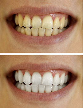Before and after dental teeth whitening case photos