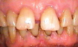 Yellow/brown teeth with visible decay and gaps