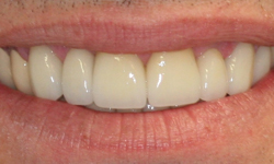 Straight, whiten teeth in perfect health