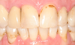 Yellowing teeth with visible decay and gum disease