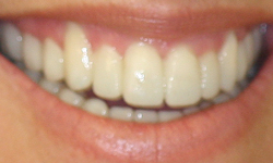 Perfectly aligned teeth