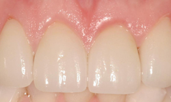 After image of straightened teeth with corrected chips