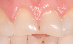 Before image of misaligned teeth with chipping