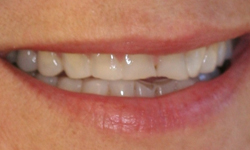 Closeup of two front teeth with cracks and chips