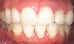 After image of two front teeth aligned with remainder of smile