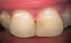 Closeup of two front teeth extending beyond other teeth