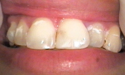 Before image of two front teeth protruding above lips