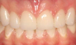After image of perfectly aligned, white teeth