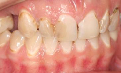 Before image of crooked teeth with visible decay