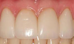 After image of white teeth with no gaps