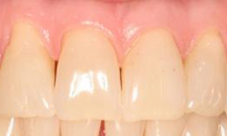 Before image of yellowing teeth with gaps