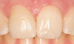After image of teenage boy's fixed front teeth