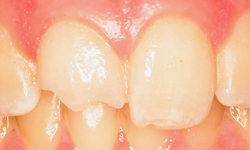 Closeup of teenage boy's broken front teeth