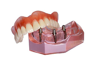 Model implant supported bridge