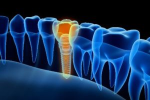 digital representation of dental implant